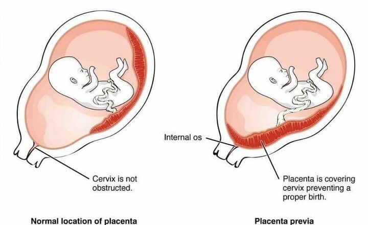 Plasenta Previa Placenta Previa Adalah Keadaan Di Mana_642b0a5fe5bee.jpeg